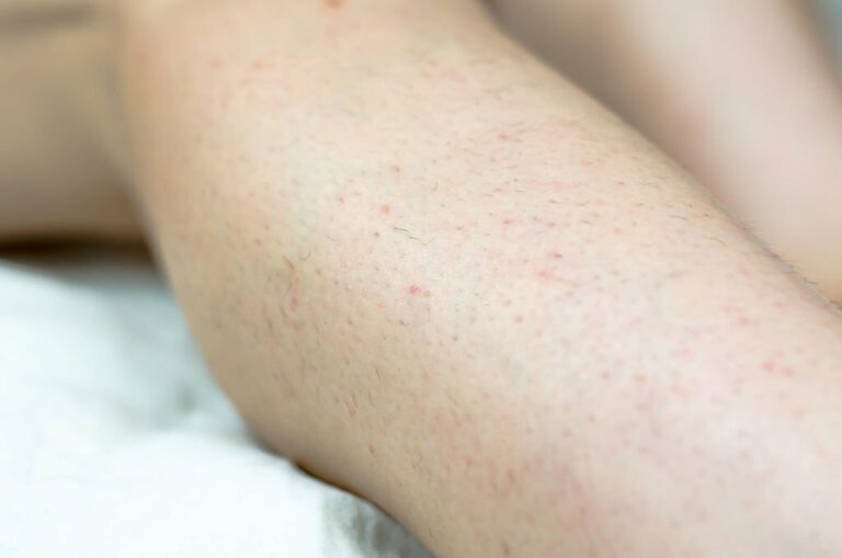 Eliminate Ingrown Hairs with Laser Hair Removal