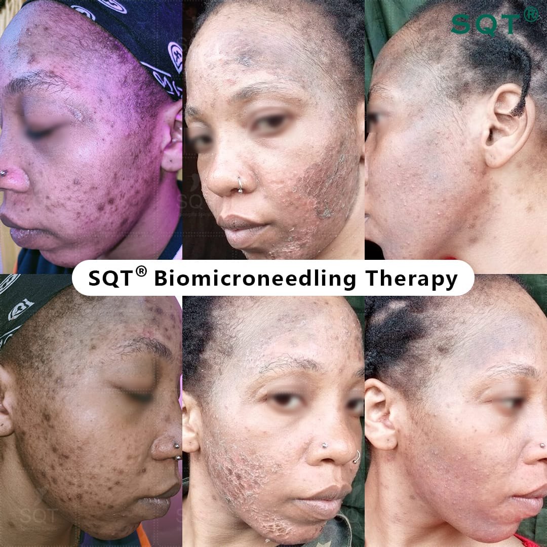 SQT clinical images of a course of bio microneedling on deeper skin, showing active acne and post-inflammatory pigmentation on the cheeks and jaw before treatment and after.