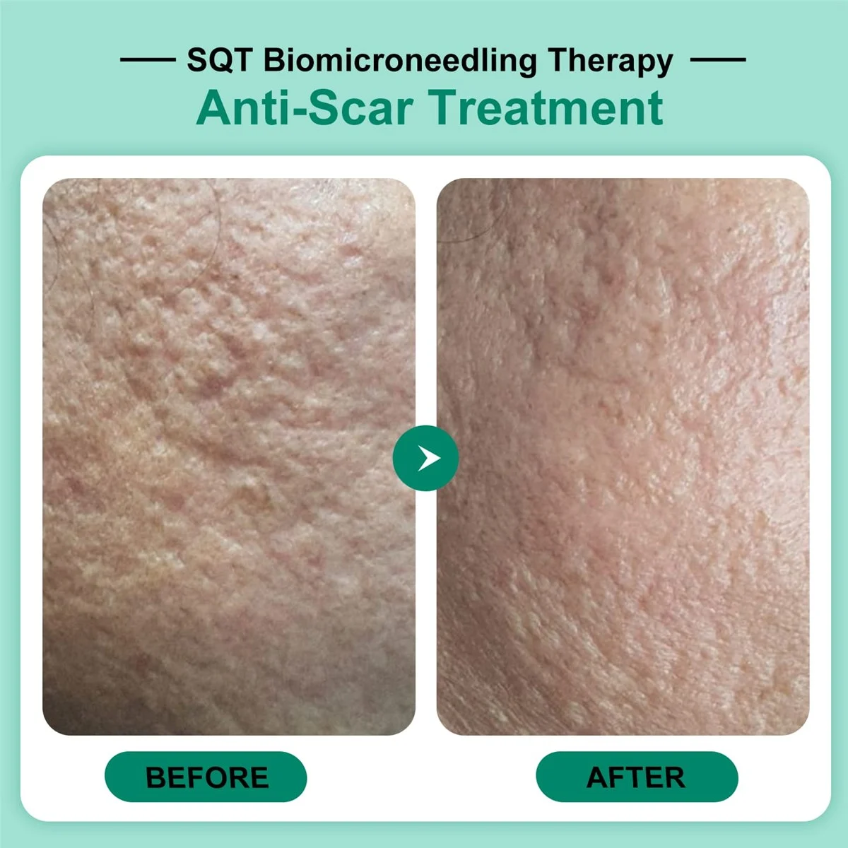 SQT clinical images of textured acne scarring on the cheek before a course of bio microneedling and after, showing smoother surface texture.