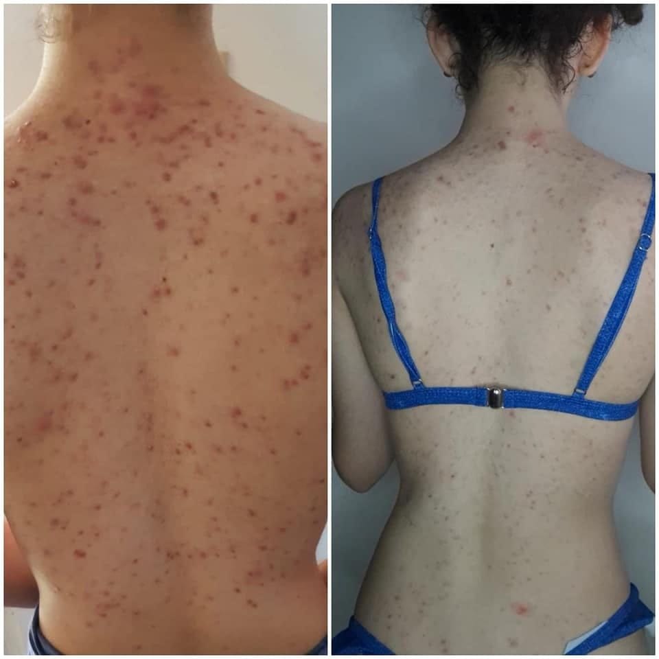 SQT clinical images of widespread inflamed acne across the upper back before a course of bio microneedling and after, showing reduced inflammation with residual marks.