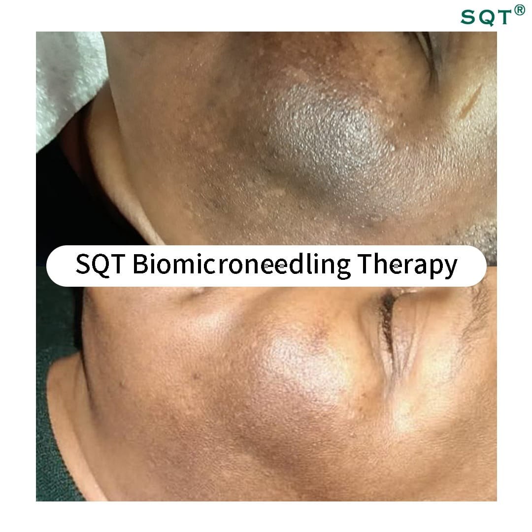 SQT clinical images of uneven pigmentation and roughness on the neck before a course of bio microneedling and after.