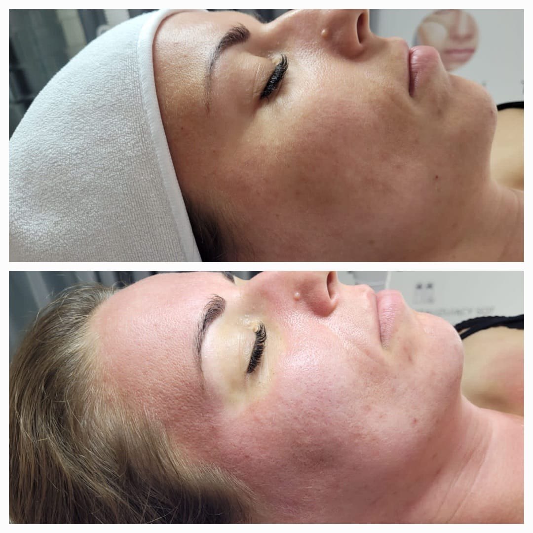 SQT clinical images of uneven tone and surface texture along the cheek and jaw before a course of bio microneedling and after.