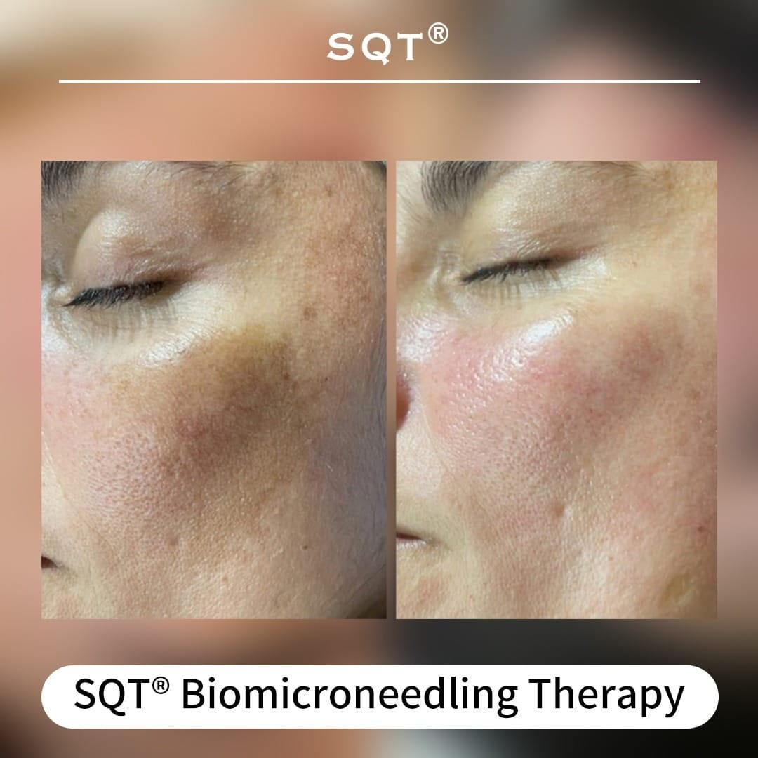 Bio microneedling treatment at Femme Laser Clinic