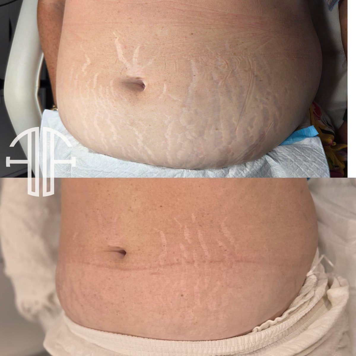 Bio Microneedling at Femme Laser Clinic