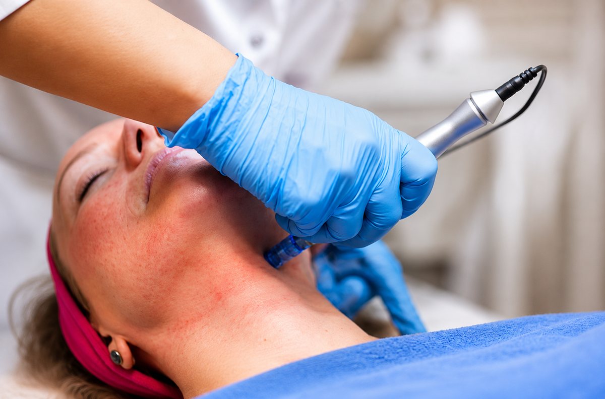 Microneedling at Femme Laser Clinic Scarborough