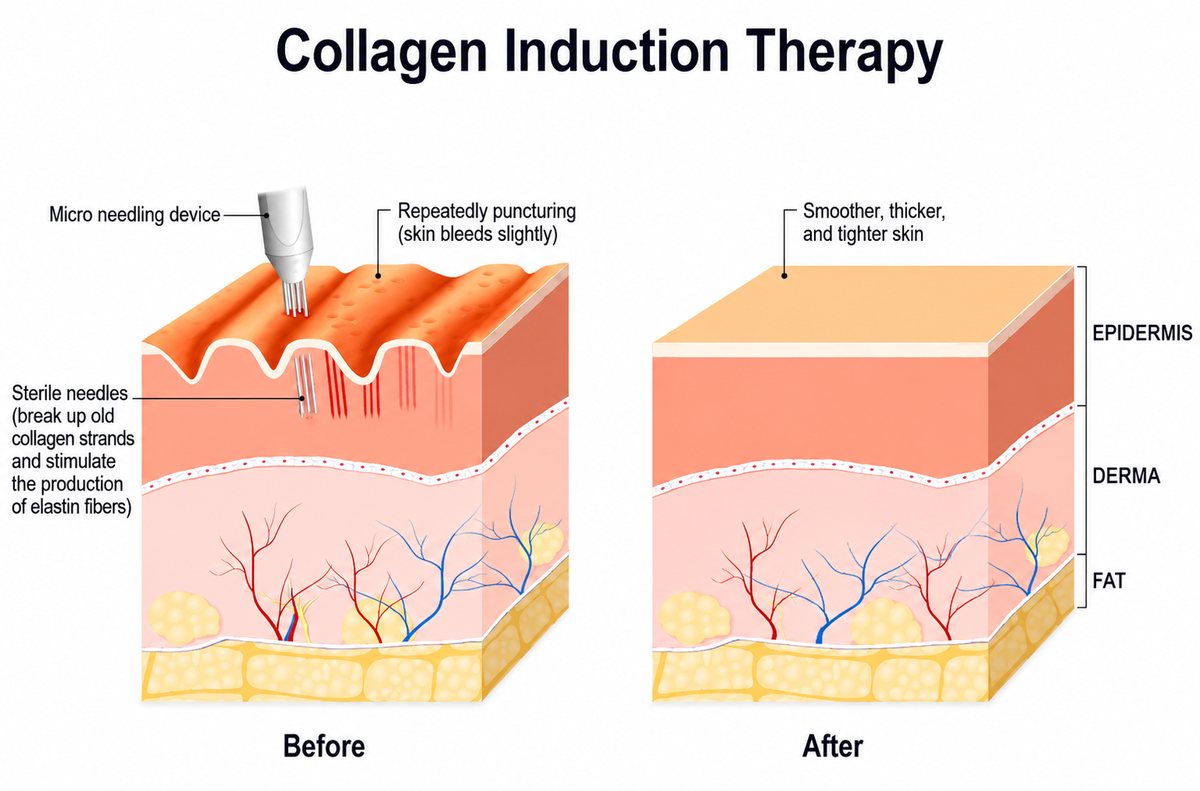 Microneedling treatment at Femme Laser Clinic Scarborough