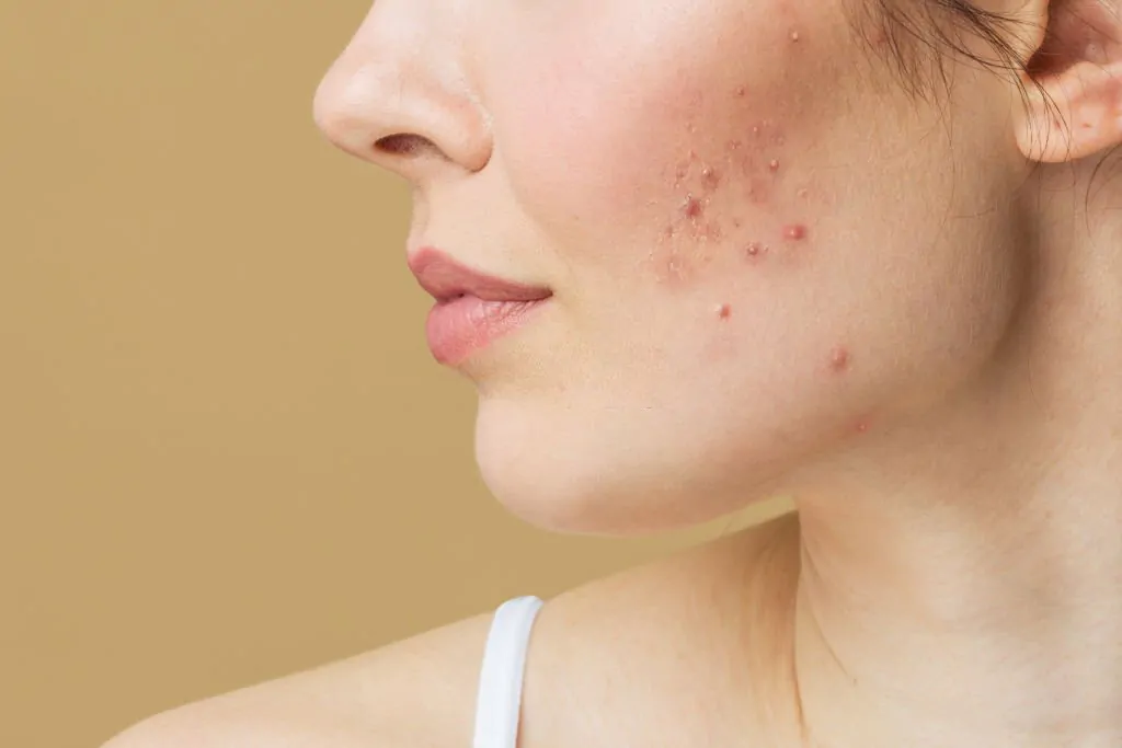 microneedling_for_acne_scars