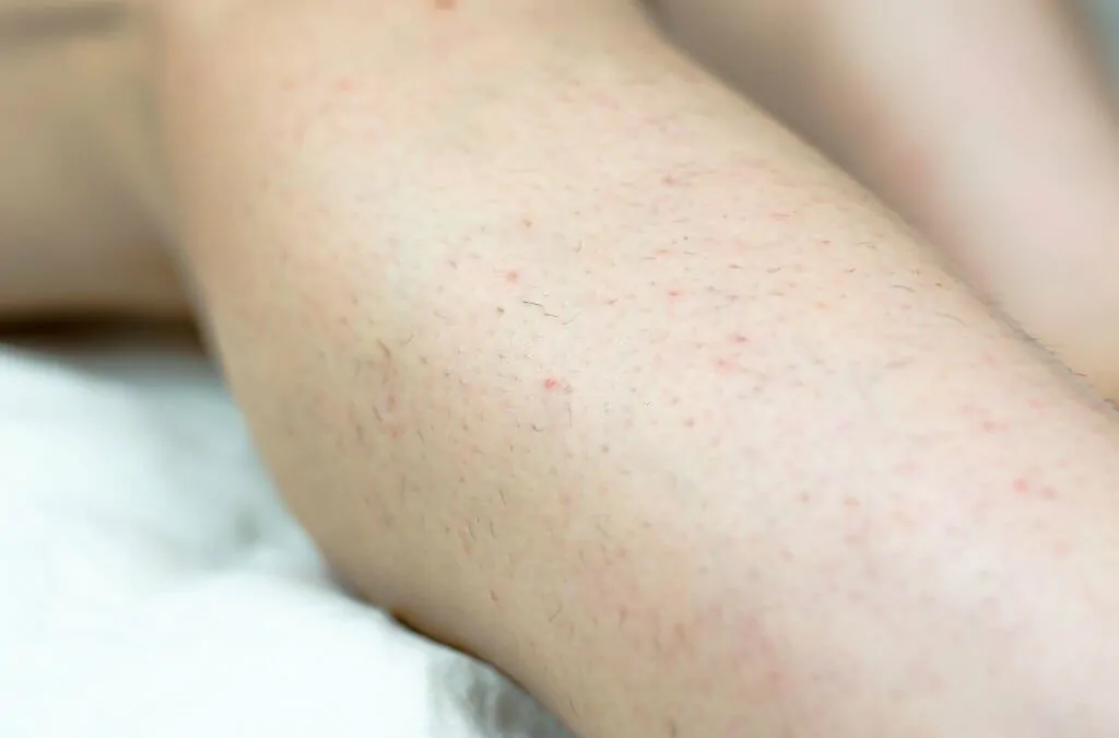 Eliminate Ingrown Hairs with Laser Hair Removal
