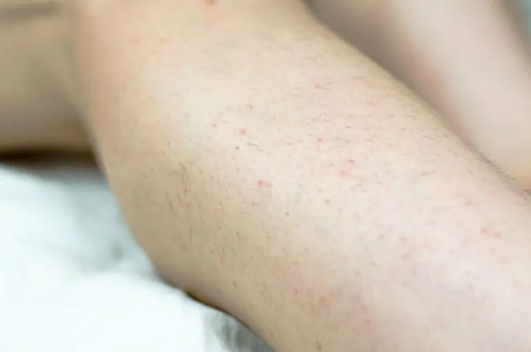 Eliminate Ingrown Hairs with Laser Hair Removal