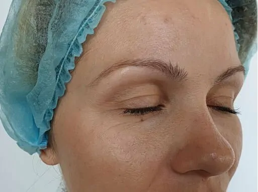 microdermabrasion-before 