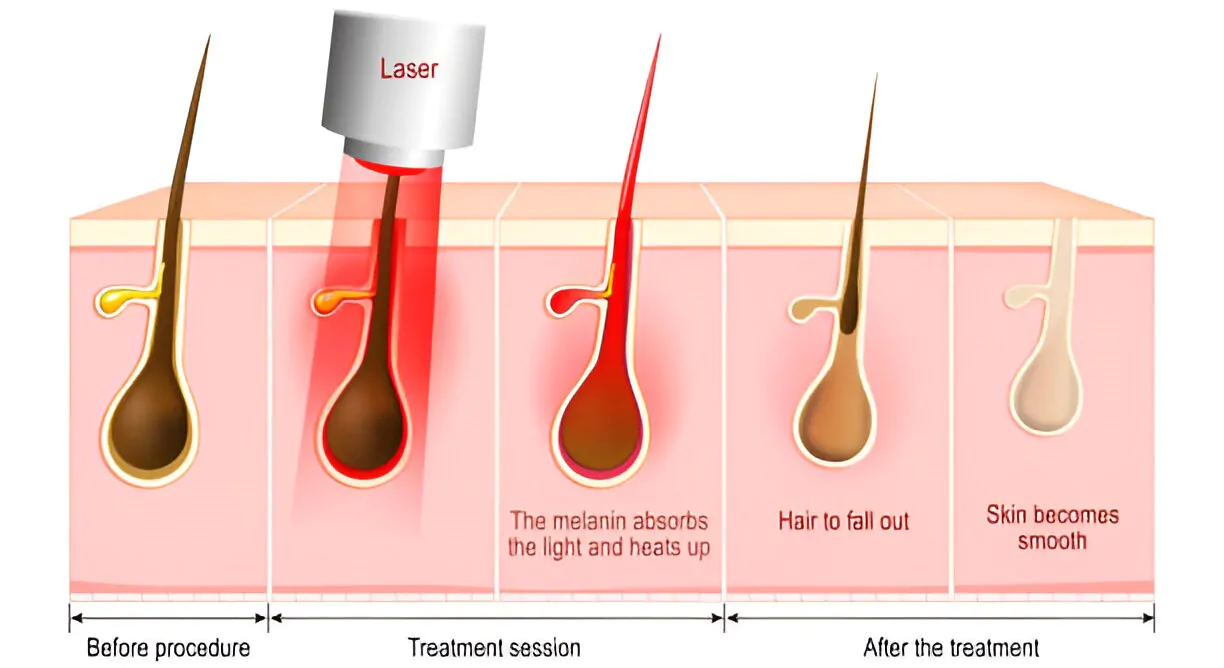 how-laser-hair-removal-works