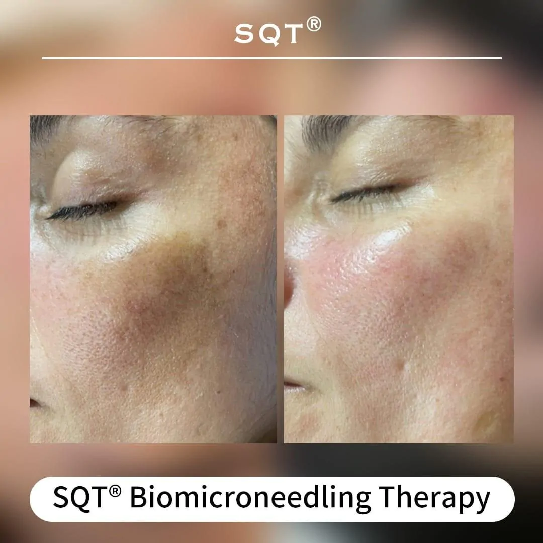 Bio microneedling treatment at Femme Laser Clinic