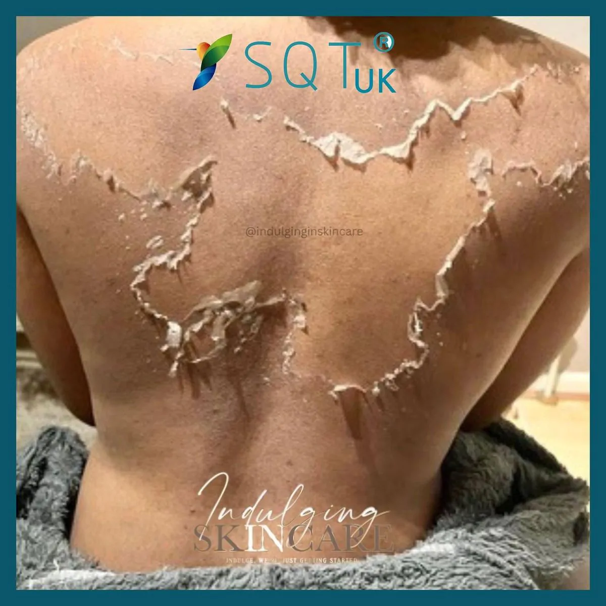 Bio Microneedling treatment at Femme Laser Clinic Midtown Toronto